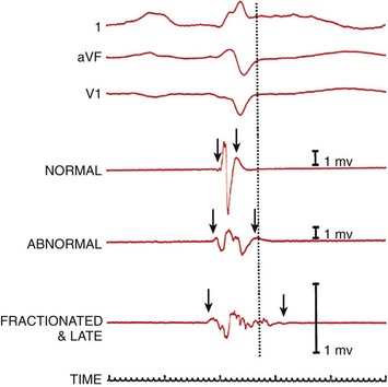 Ischemic Heart Disease | Thoracic Key