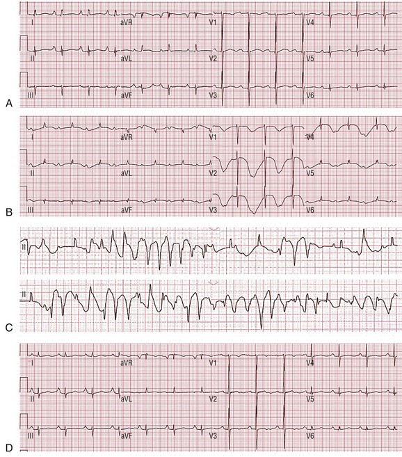 Ventricular Arrhythmias in Takotsubo Cardiomyopathy | Thoracic Key