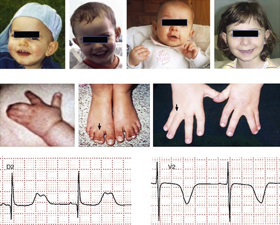 Timothy Syndrome | Thoracic Key