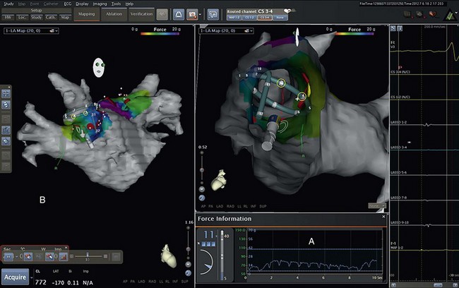 Ablation For Atrial Fibrillation 