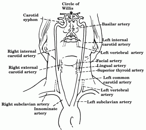 Great Vessel and Carotid Occlusive Disease | Thoracic Key