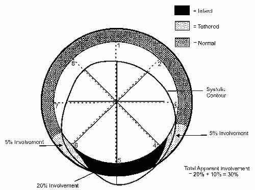 Regional wall motion abnormalities in coronary artery disease – All About  Cardiovascular System and Disorders