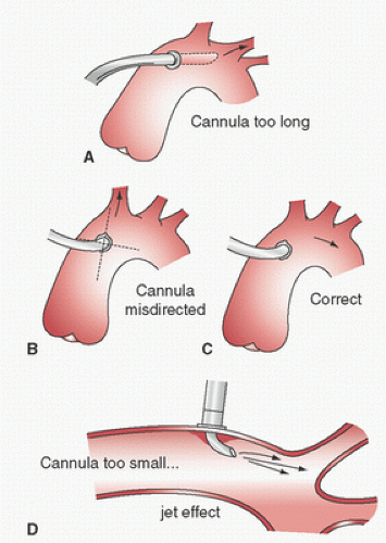 Biomedicus Cannula Flow Chart
