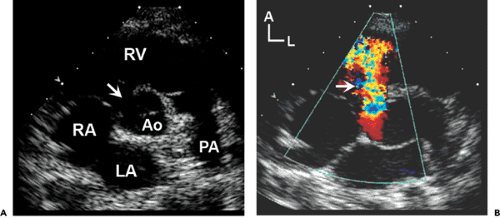 Echocardiography in Congenital Heart Disease: An Overview | Thoracic Key