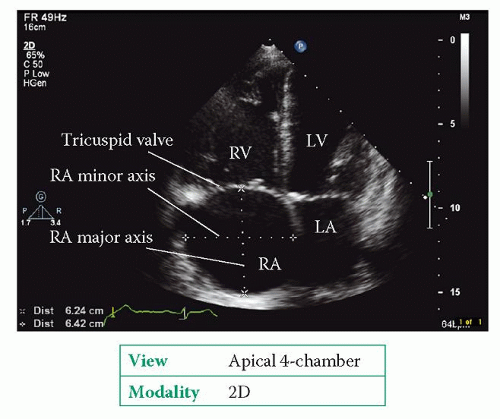 the-right-heart-thoracic-key