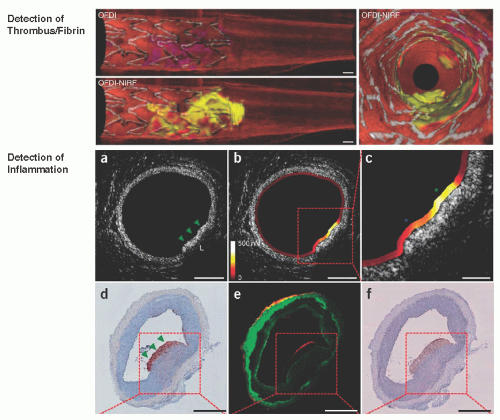 Intravascular Imaging Techniques | Thoracic Key