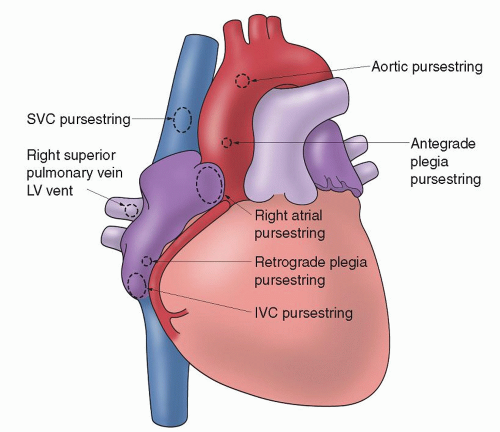 cardiopulmonary bypass cannulation