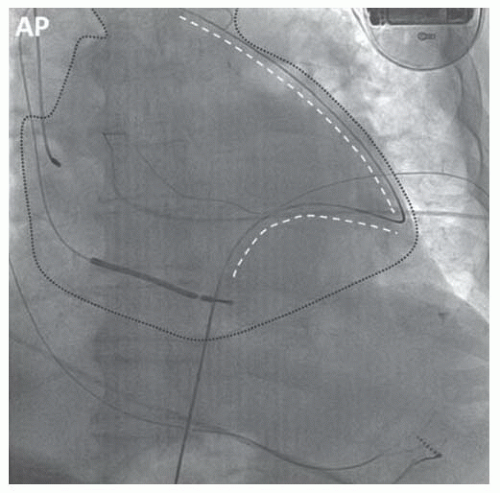 Pericardial Interventions: Pericardiocentesis, Balloon Pericardiotomy ...