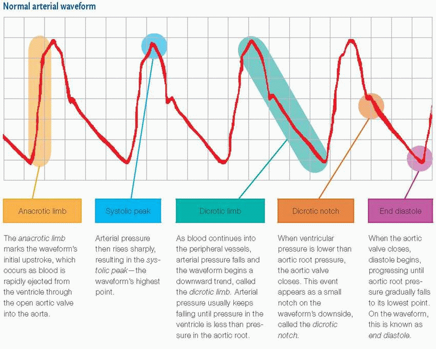 Art Line Waveform Interpretation - Get More Anythink's