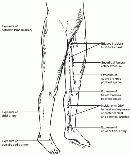 Open Surgical Revascularization For Femoropopliteal And Infrapopliteal 