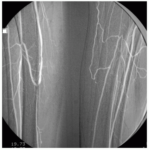 Lower-extremity Amputation | Thoracic Key