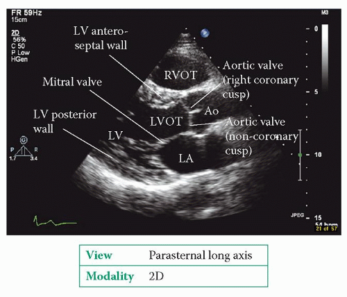 M-Mode Echocardiography and 2D Cardiac Measurements*