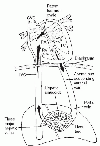 Anomalies of Pulmonary Venous Return | Thoracic Key