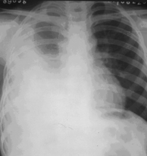 Parapneumonic Empyema | Thoracic Key