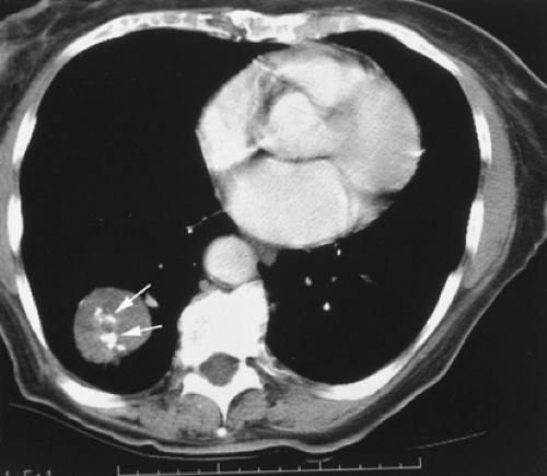 calcified lung adenocarcinoma ct