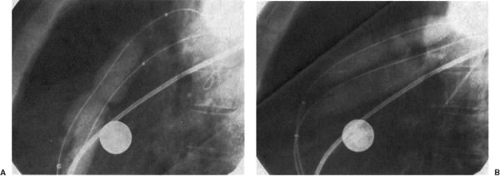 Cardiac Catheterization And Hemodynamic Assessment | Thoracic Key