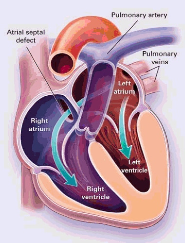 Congenital Heart Disease | Thoracic Key