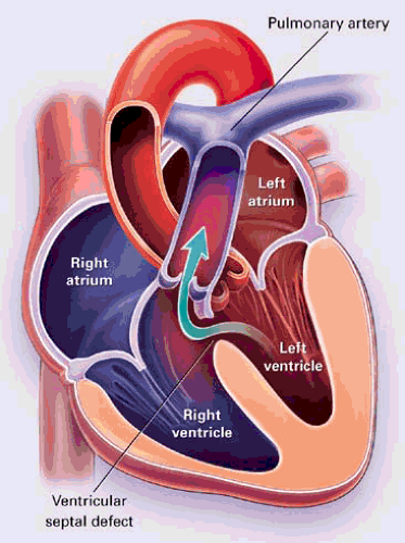 Congenital Heart Disease | Thoracic Key