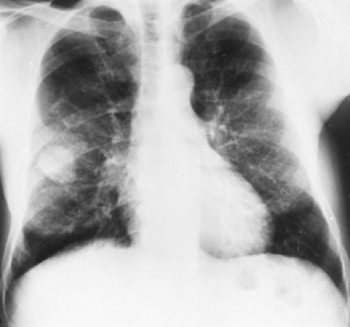 uncommon-primary-malignant-tumors-of-the-lung-thoracic-key