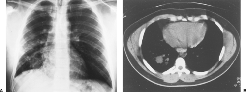 Uncommon Primary Malignant Tumors of the Lung | Thoracic Key