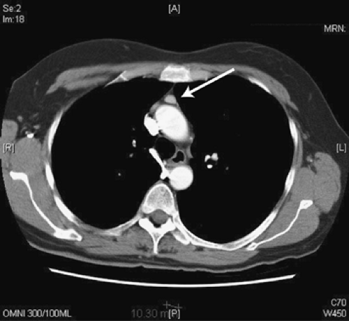 Video-Assisted Thoracic Surgery for Diseases Within the Mediastinum ...