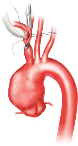 how is aortic aneurysm surgery performed