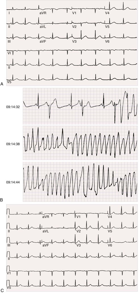 Neurologic Disorders And Cardiovascular Disease | Thoracic Key