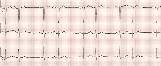 atrial and ventricular ectopy