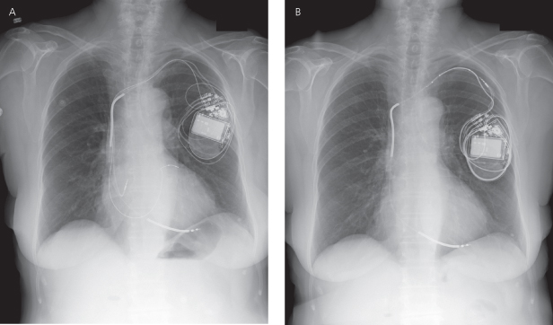 Radiography of Implantable Devices | Thoracic Key