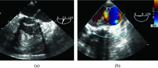 Complex Mitral Valve Repair: Triangular Resection, Annuloplasty, and  Chordal Replacement With Premeasured Loops | CTSNet