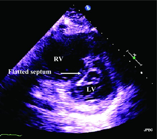 trivial pericardial effusion