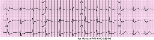 26. Managing Ventricular Tachycardia | Thoracic Key