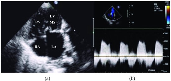 babies with interrupted aortic arch syndrome