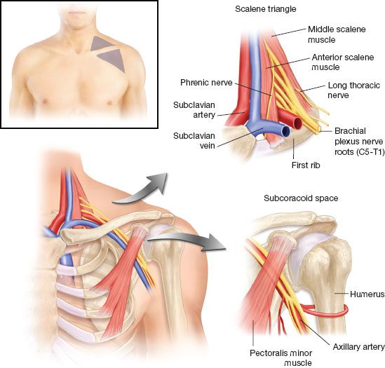 Prehab®️ on X: Pain with Thoracic Outlet Syndrome (TOS) presents anywhere  between the neck, face, occipital region or into the chest & shoulder, with  paresthesia into the upper extremity based on where