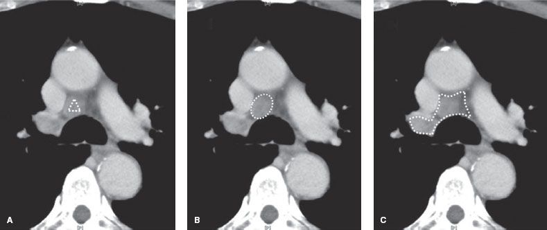 Mediastinal Node Dissection Right/Left (VATS/Open) | Thoracic Key