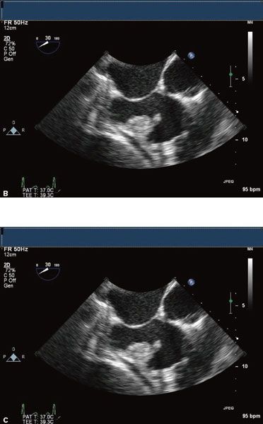 Radio Femoral Delay