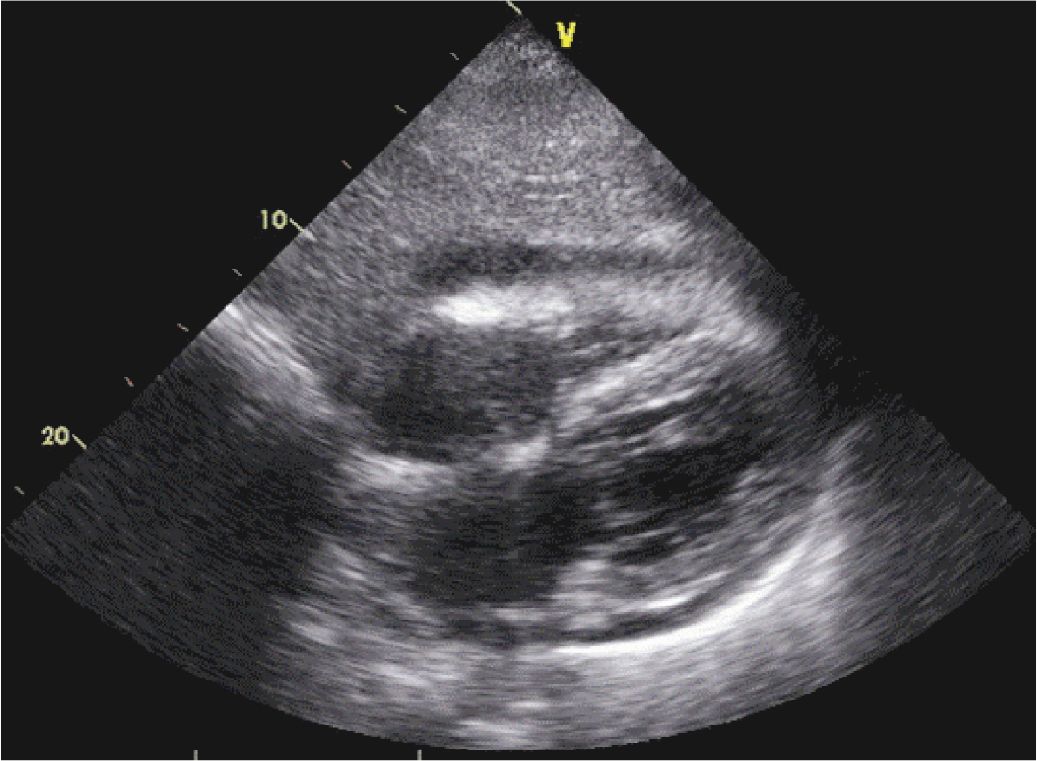 Echocardiographic Assessment Of Pericardial Disease Thoracic Key