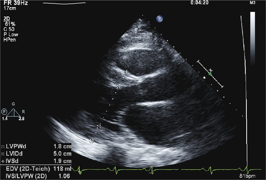 Echocardiographic features of left ventricular dysfunction and outcomes in  chronic kidney disease