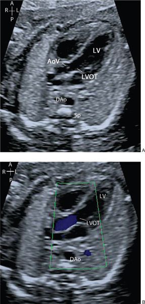 Fetal Lvot Ultrasound