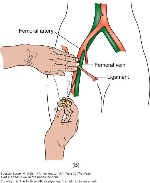 Heart Catheterization Procedure Through Femoral Artery At Debbie Heart Catheterization Procedure Through Femoral Artery At Debbie