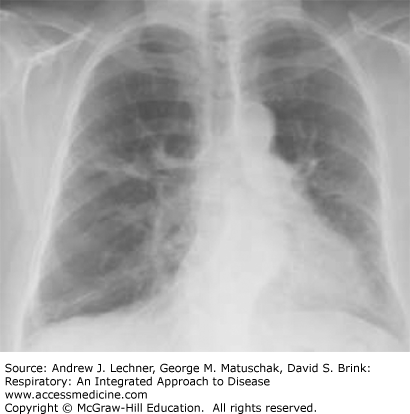 Management of Restrictive Lung Diseases | Thoracic Key