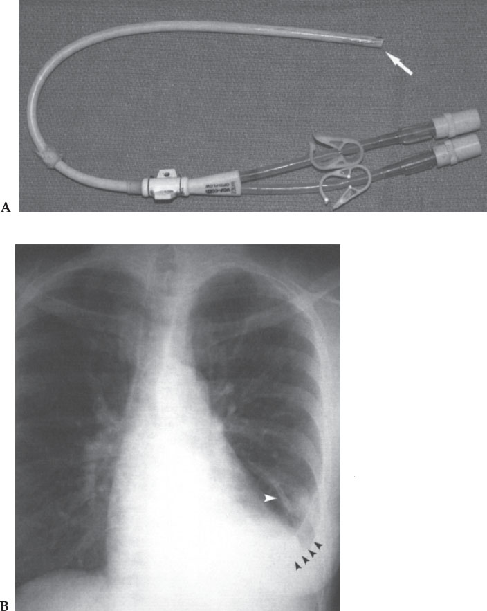 Tesio Catheter