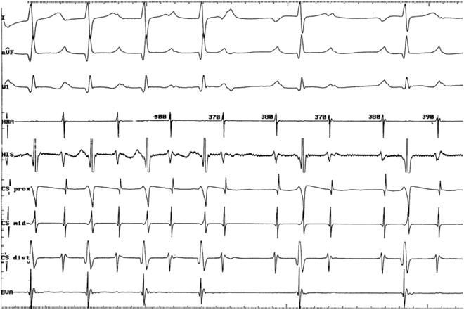 Atrial Ectopic Tachycardias Thoracic Key