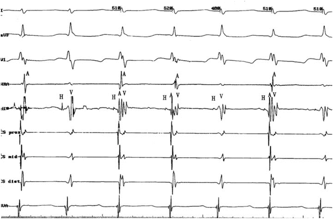 junctional tachycardia