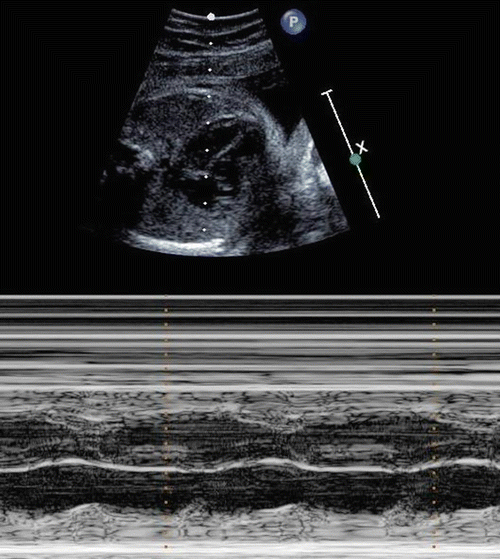 Second-degree atrioventricular block (fetal echocardiography