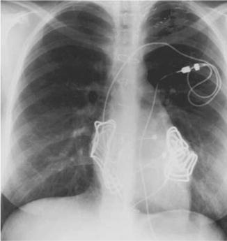 Cardiac Pacemakers And Implantable Cardiovascular Defibrillators Thoracic Key