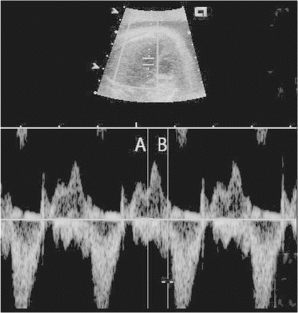 Mechanical PQ intervals (in milliseconds) according to fetal heart