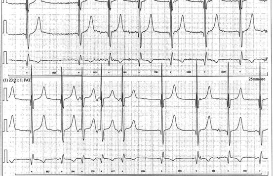 A Child with a Long QT? | Thoracic Key