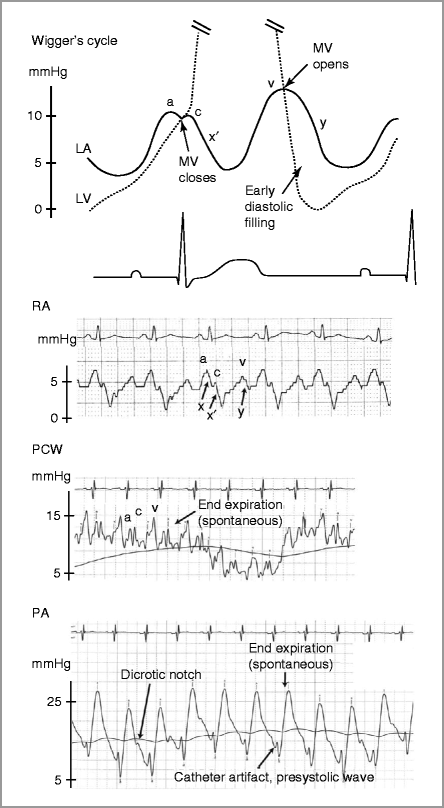 Cardiac Catheterization, Coronary Arteriography and Intravascular ...