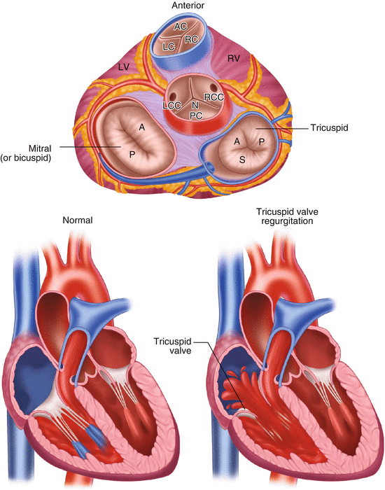 tricuspid-valve-tricuspid-regurgitation-thoracic-key